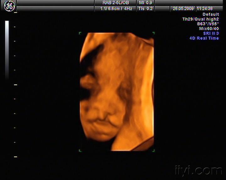 胎儿双侧唇裂四维成像图
