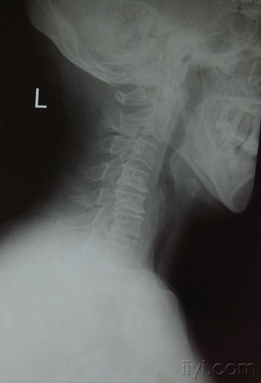 颈椎3-4,4-5,5-6,6-7椎间盘突出症,请各位爱友帮我看看!