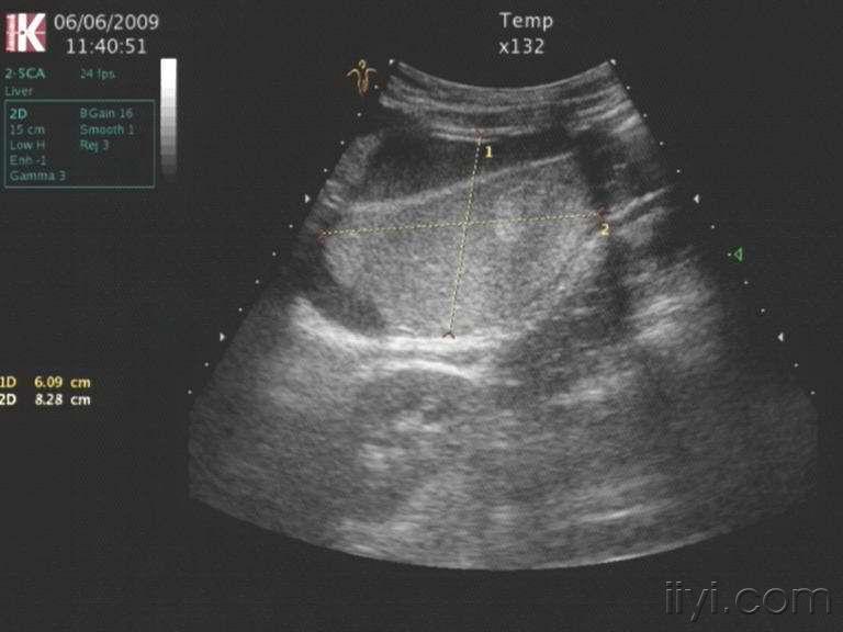 腹部巨大畸胎瘤 - 超声医学讨论版 - 爱爱医医学论坛