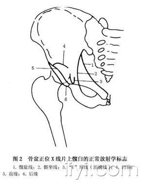 髋臼骨折的解剖示意图