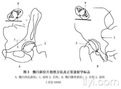 髋臼骨折的解剖示意图