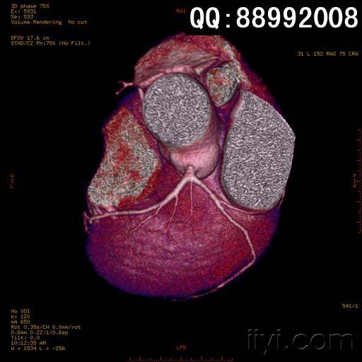 冠状动脉ct三维重建1