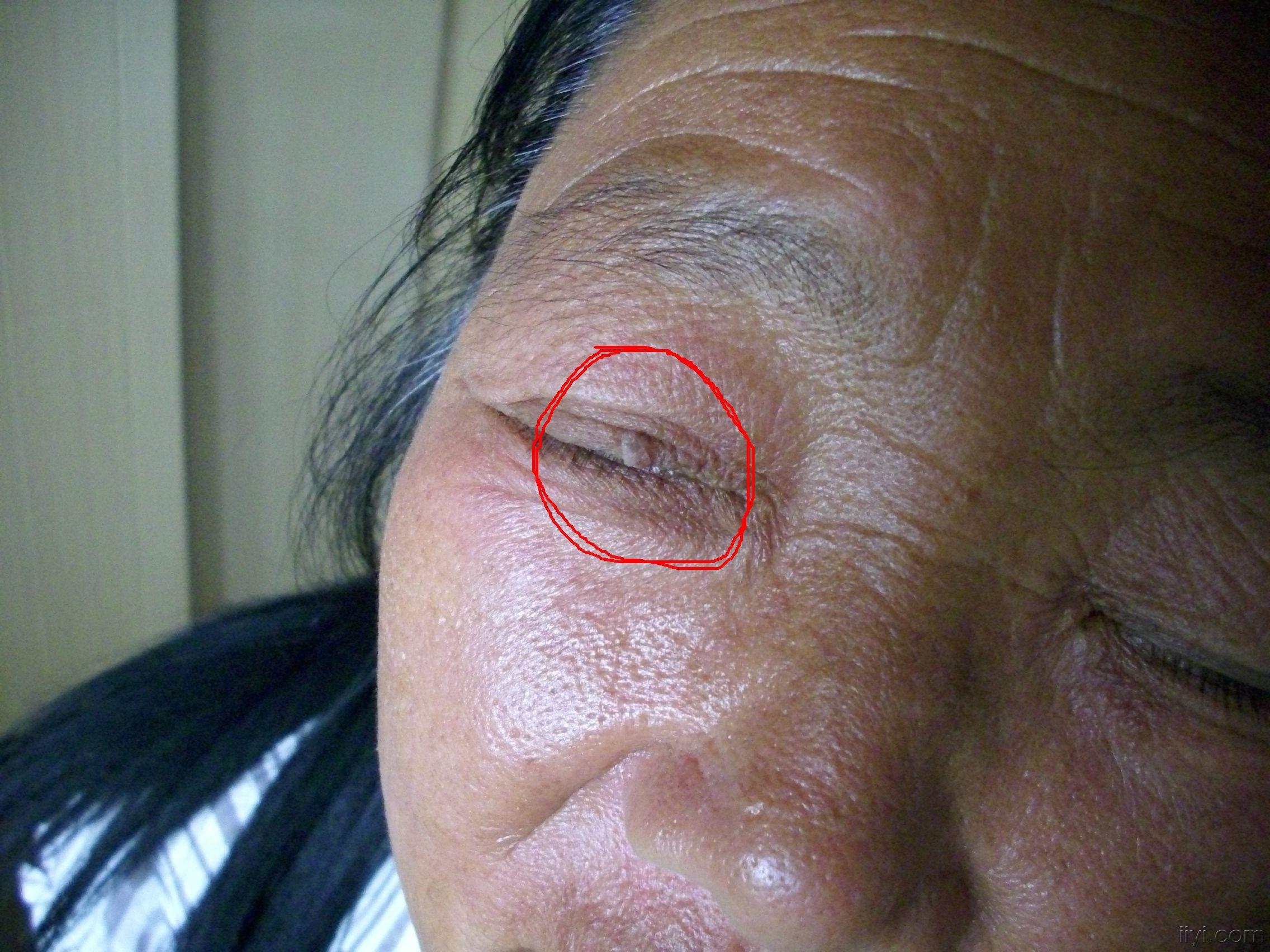 患者女,50岁.右侧上眼皮,肉疙瘩2年.   激光能打去吗.