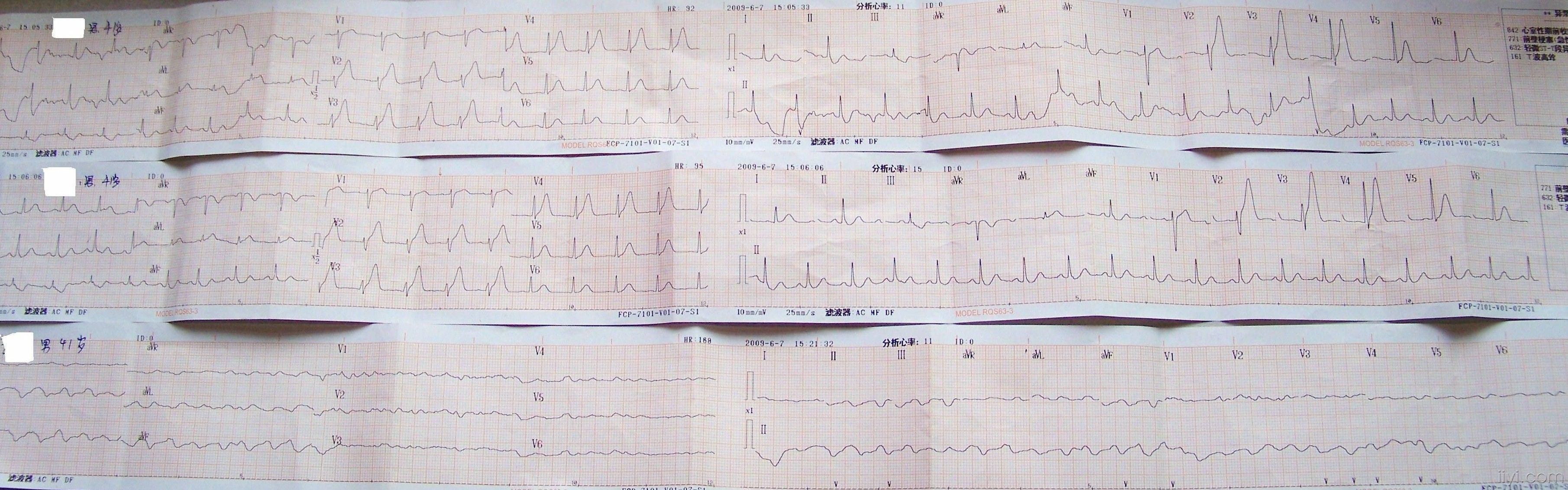 一例猝死的心电图请大家帮忙看看