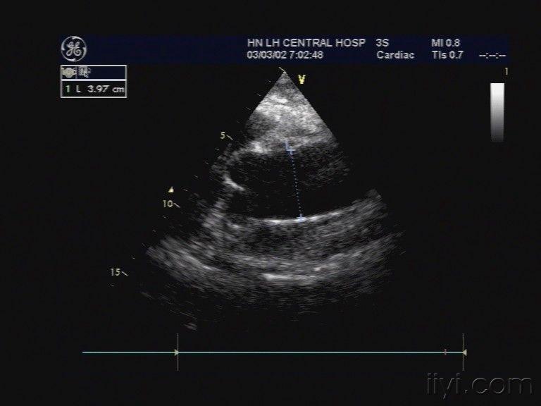 主动脉夹层iii型 - 超声医学讨论版 - 爱爱医医学论坛