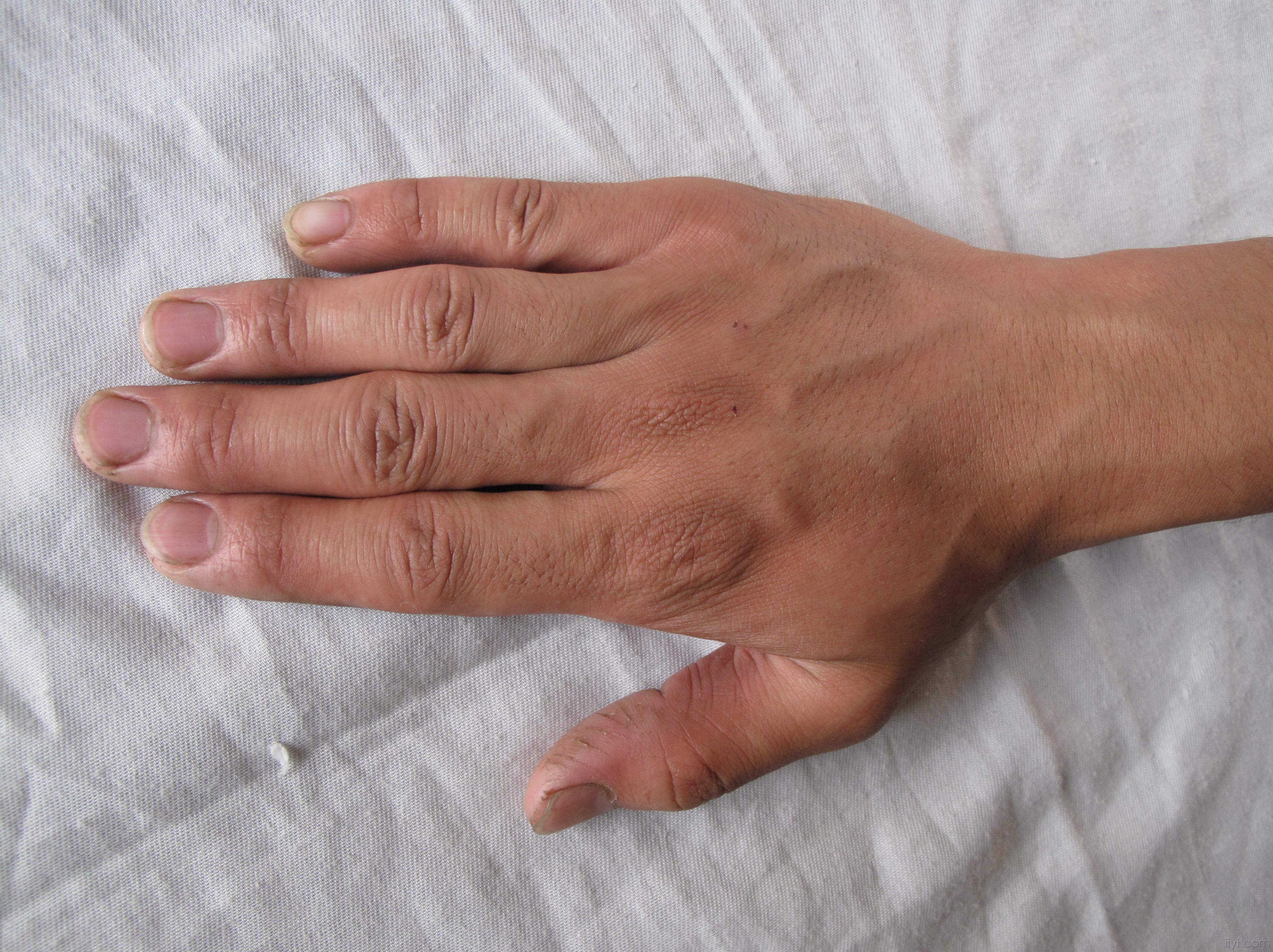 双手 掌面干裂 - 皮肤及性传播疾病讨论版 - 爱爱医