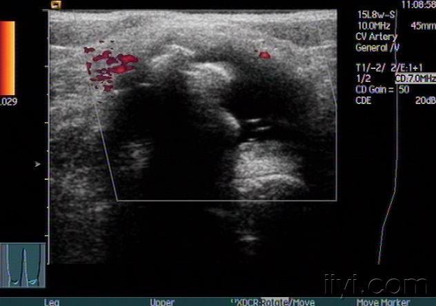 双侧腘窝囊肿声像图 - 超声医学讨论版 - 爱爱医医学论坛