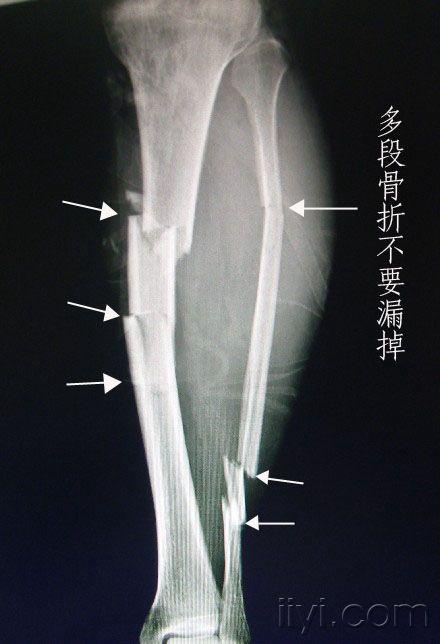 左胫腓骨粉碎性骨折