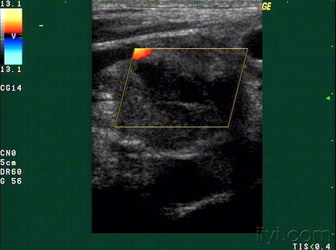 右颈静脉血栓? - 超声医学讨论版 - 爱爱医医学论坛