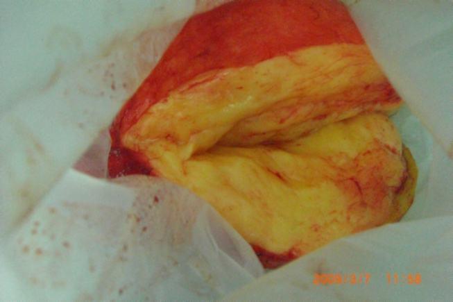 讨论切除巨大脂肪瘤(></p></a>20cm)1例