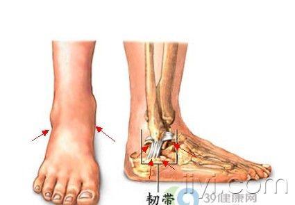 踝关节反复疼痛