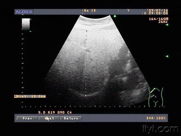 非常典型的脂肪肝伴局灶性脂肪肝未浸润灶 超声医学讨论版 爱爱医