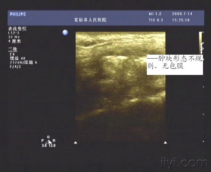 颈部肿块(蜂窝织炎?) - 超声医学讨论版 - 爱爱医医学论坛