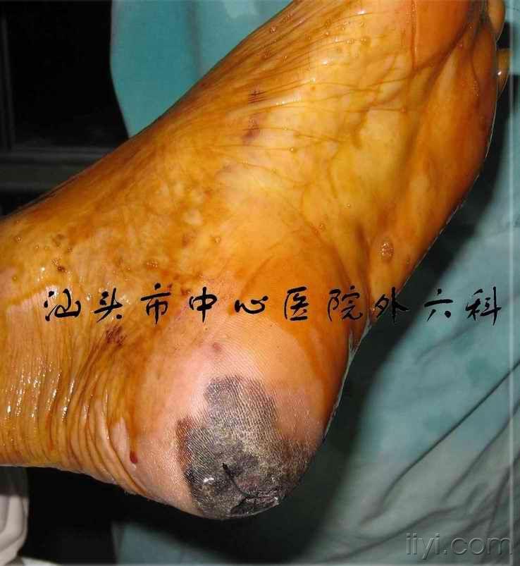 足底内侧岛状皮瓣修复足跟恶性黑色素瘤