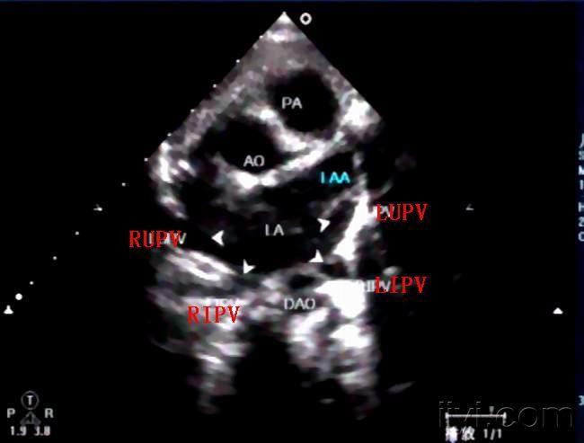 肺静脉 - 超声医学讨论版 - 爱爱医医学论坛