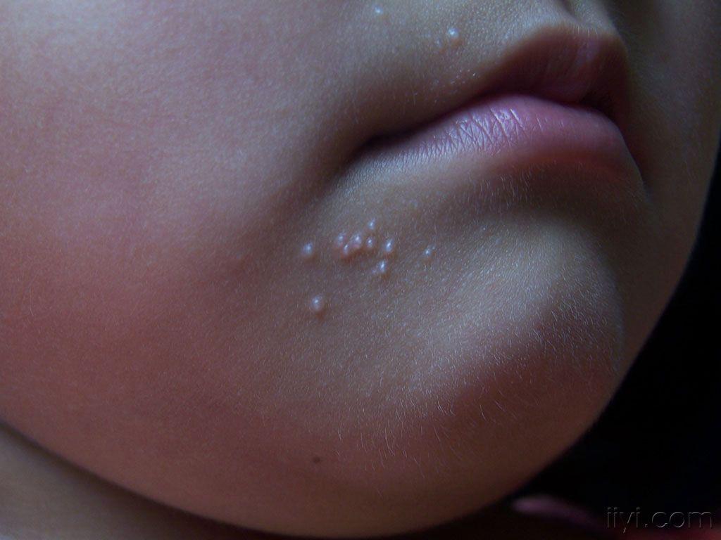 嘴角皮疹(有图)