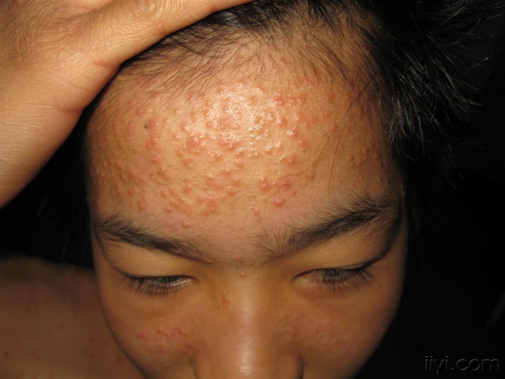 看图识病泛发性马拉色菌毛囊炎