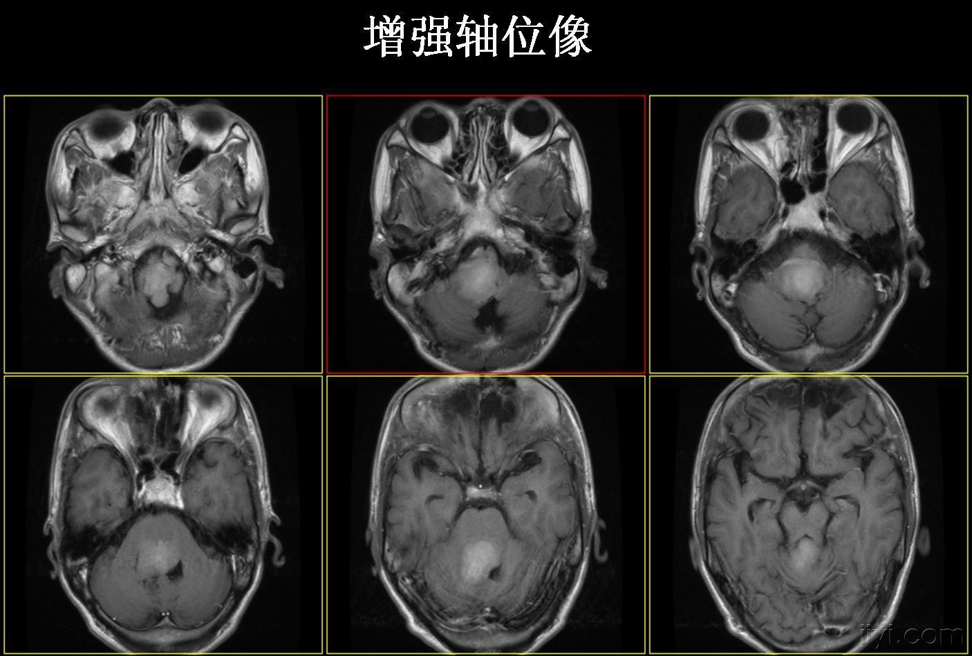 读片后颅窝病变mri及ct病理结果已公布20090811