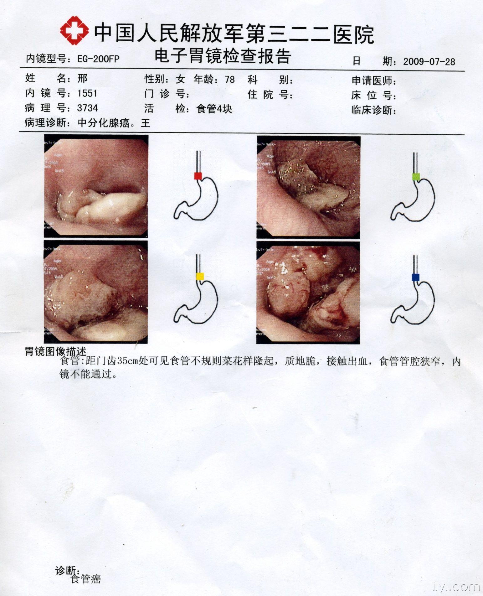 食道癌 - 肿瘤医学专业讨论版 - 爱爱医医学论坛