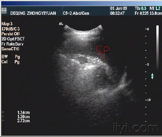 副脾? - 超声医学讨论版 - 爱爱医医学论坛