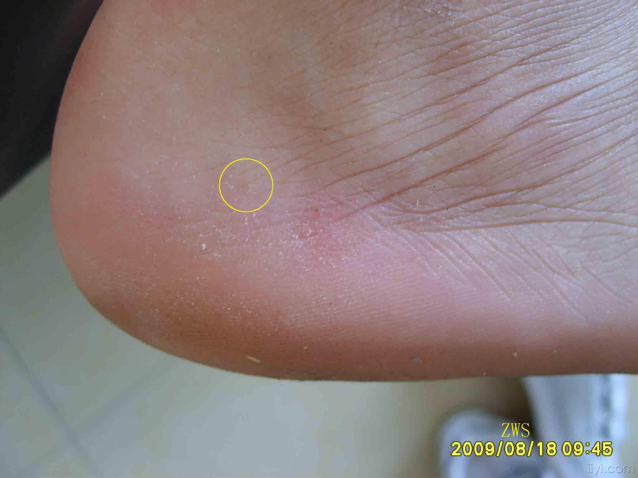 成人手足口病一例
