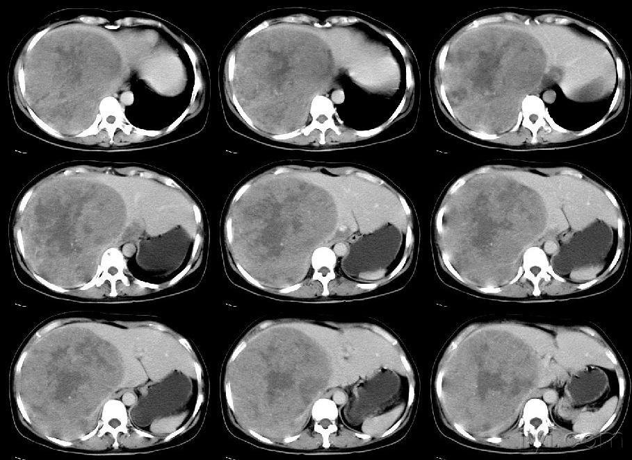 肝脏占位/ct/公布病理!09/08/21