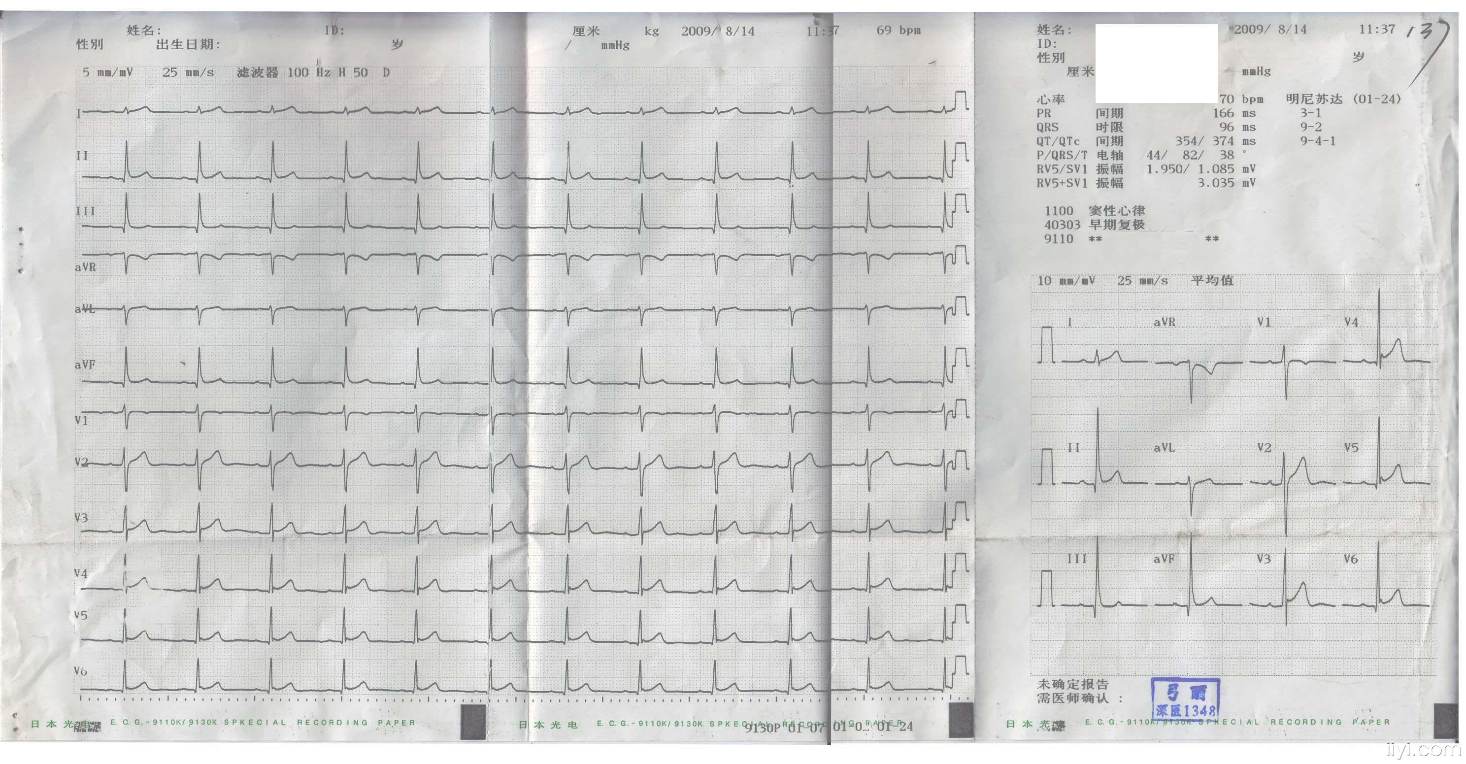 麻烦看一下我的心电图,这个早期复极综合征(29岁),怎么治疗,后果有多