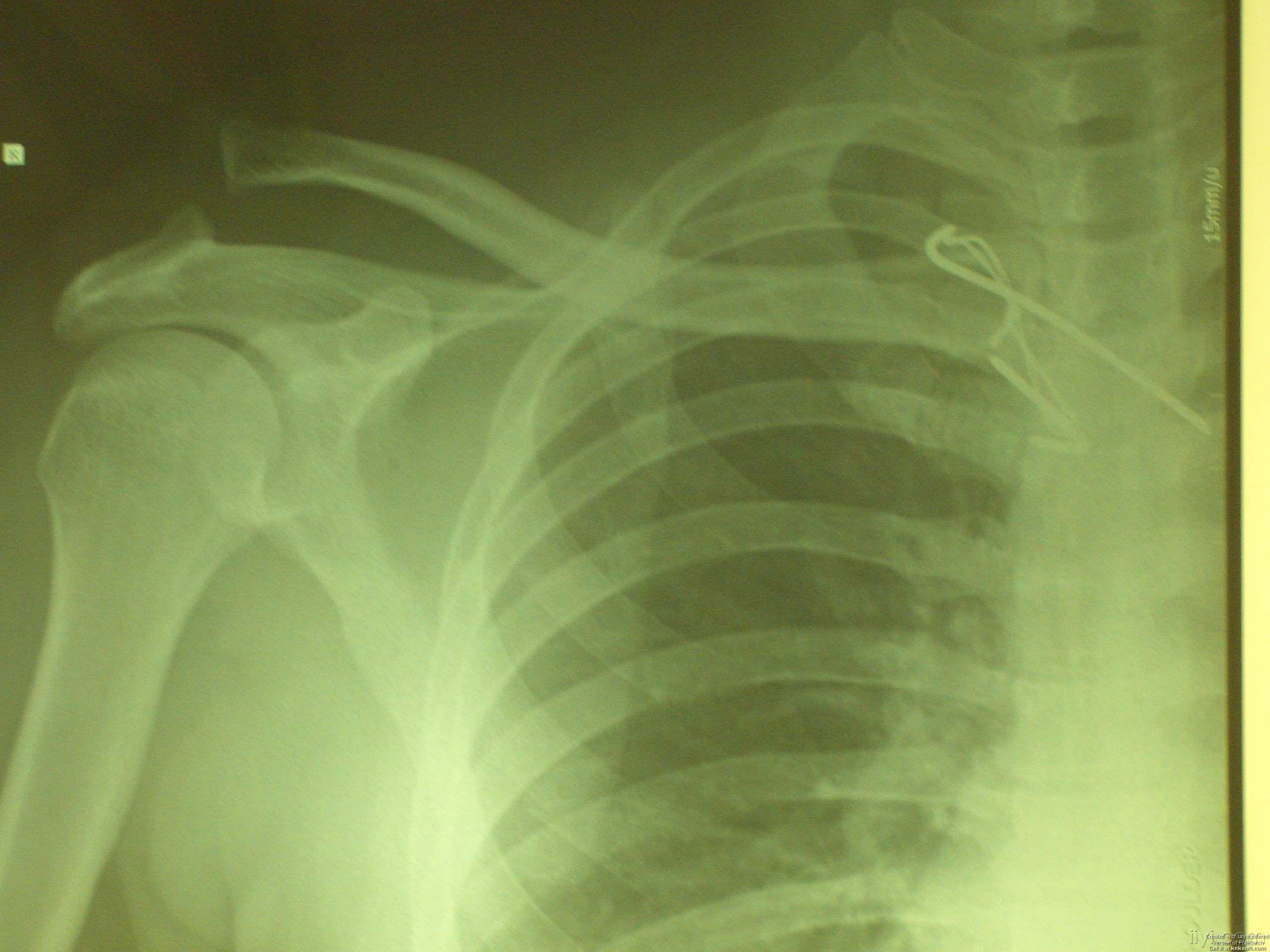 病例讨论胸锁关节脱位并肩锁关节脱位