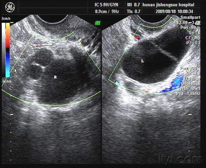 请教:有可能是卵巢囊腺瘤吗 超声医学讨论版 爱爱医医学论坛
