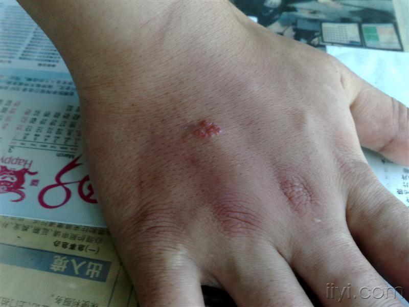 梅毒有这种皮疹吗?