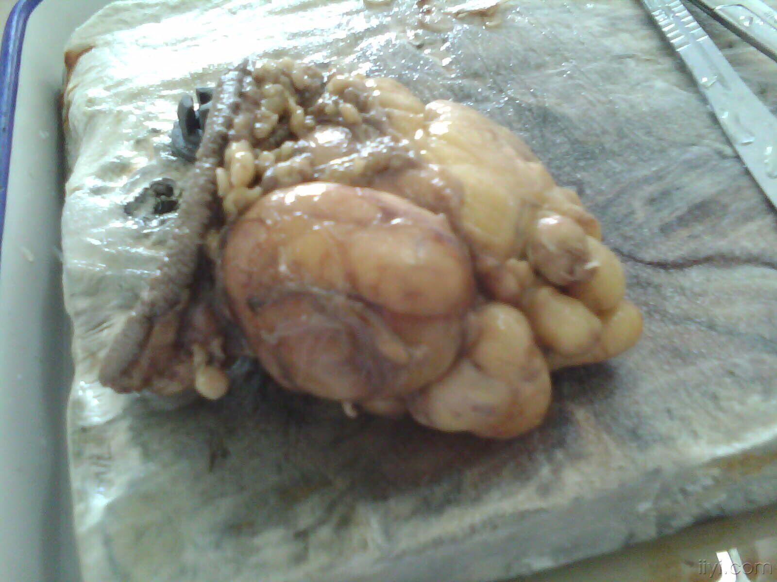 右臀部一块大赘肉长了7-8年,最近有点疼,切之.(有大