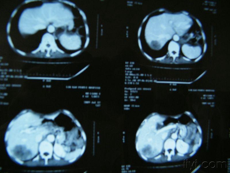 一例食管癌肝转移的ct片