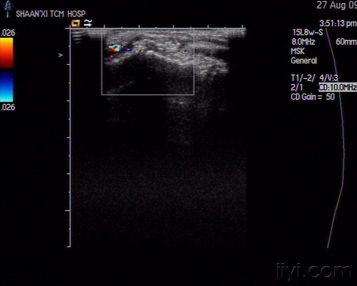 骨软骨瘤 - 超声医学讨论版 - 爱爱医医学论坛