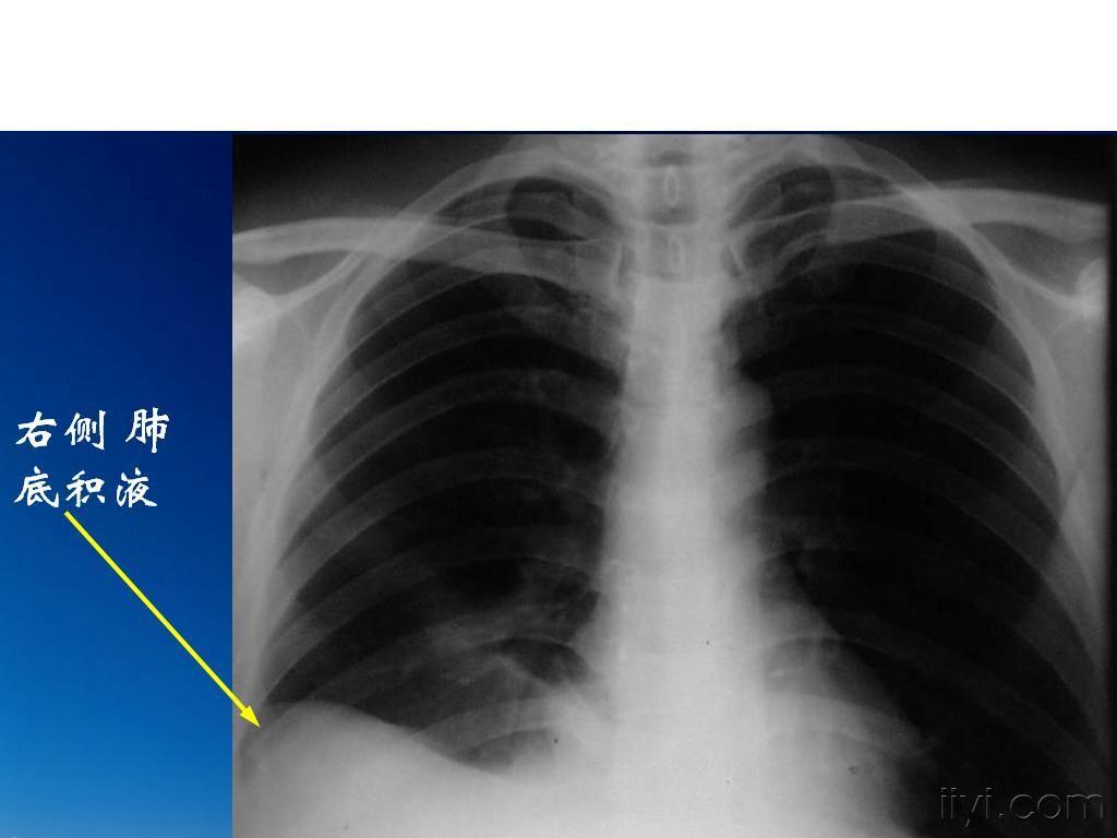 医学影像学讨论版 69 求《肺底积液x线和ct》图    肺底积液:胸腔内