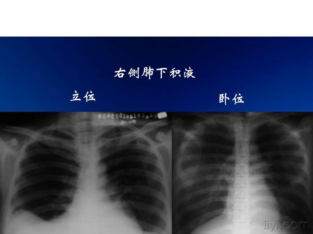 求《肺底积液x线和ct》图