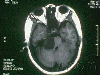 右侧桥小脑角区表皮样囊肿?