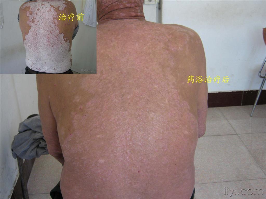 一个银屑病患者的治疗治疗前后图片 - 皮肤及性传播版