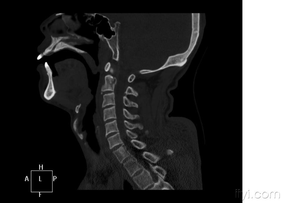 颈髓损伤枢椎胸3椎体压缩性骨折