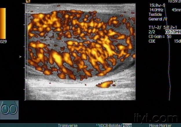 急性睾丸炎声像图—zengerya 超声医学讨论版 爱爱医医学论坛