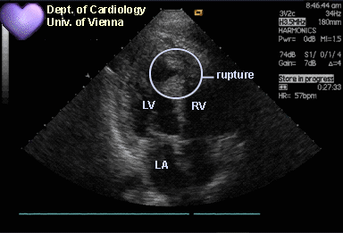心肌梗塞的超声表现