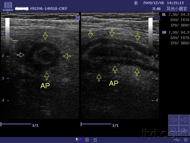 阑尾炎 - 超声医学讨论版 - 爱爱医医学论坛