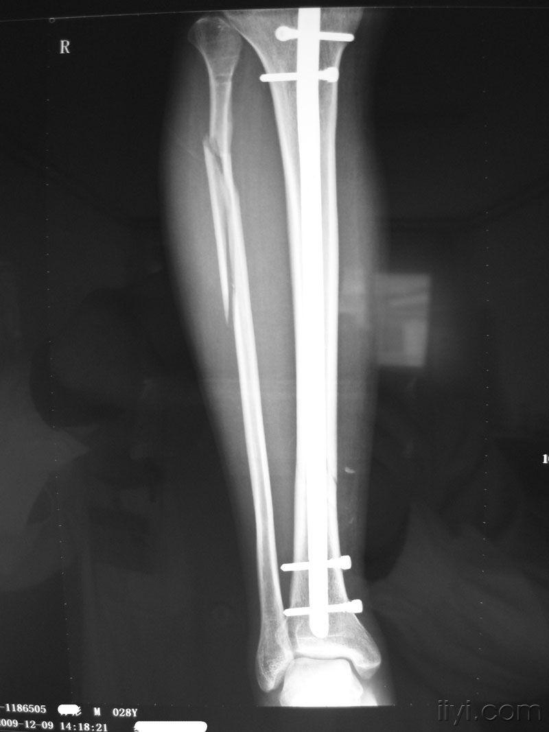 右胫腓骨骨折髓内钉固定