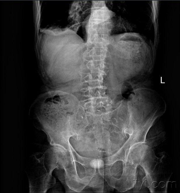 腹部站立位平片讨论 - 医学影像学讨论版 - 爱爱医