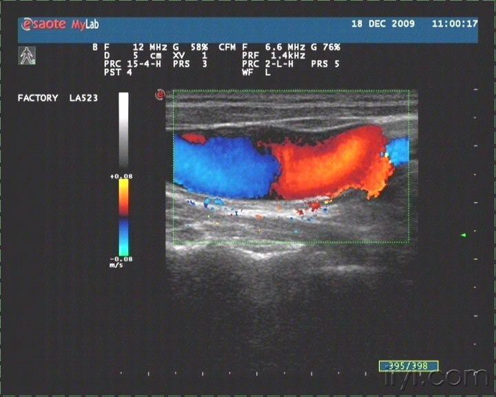 第一次见,可以考虑真性动脉瘤吗 超声医学讨论版 爱爱医医学论坛