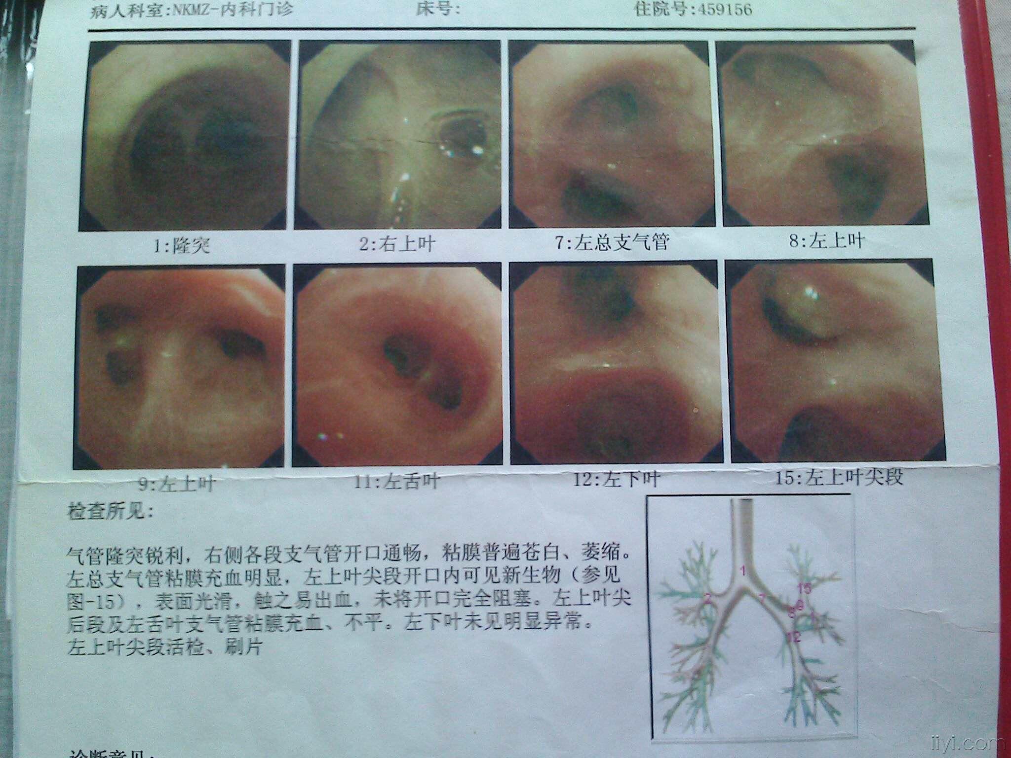 [病案讨论] 支气管镜检查