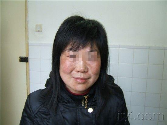 谁那里有雀斑和黄褐斑的图片呢?