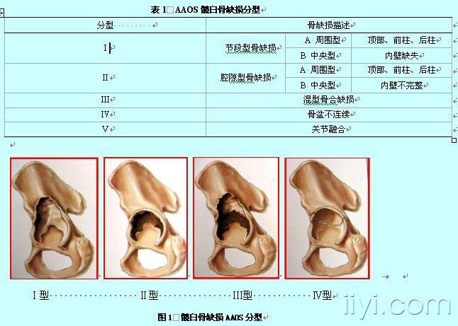 髋臼翻修