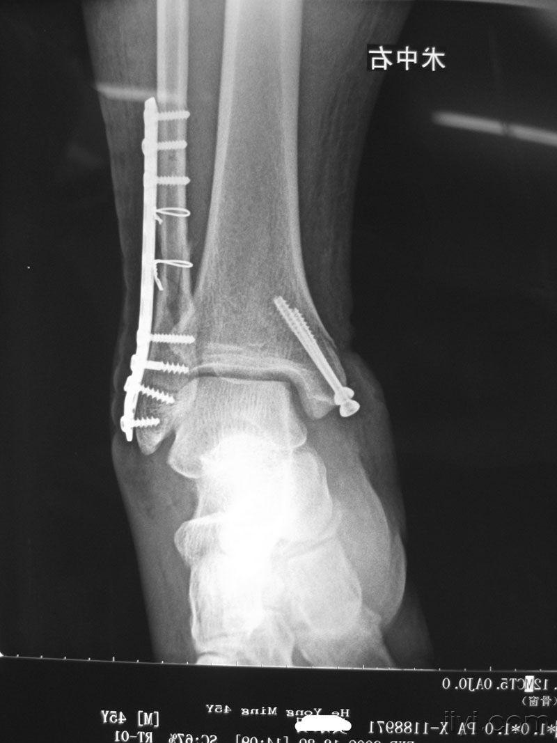 右三踝骨折伴脱位内固定一例