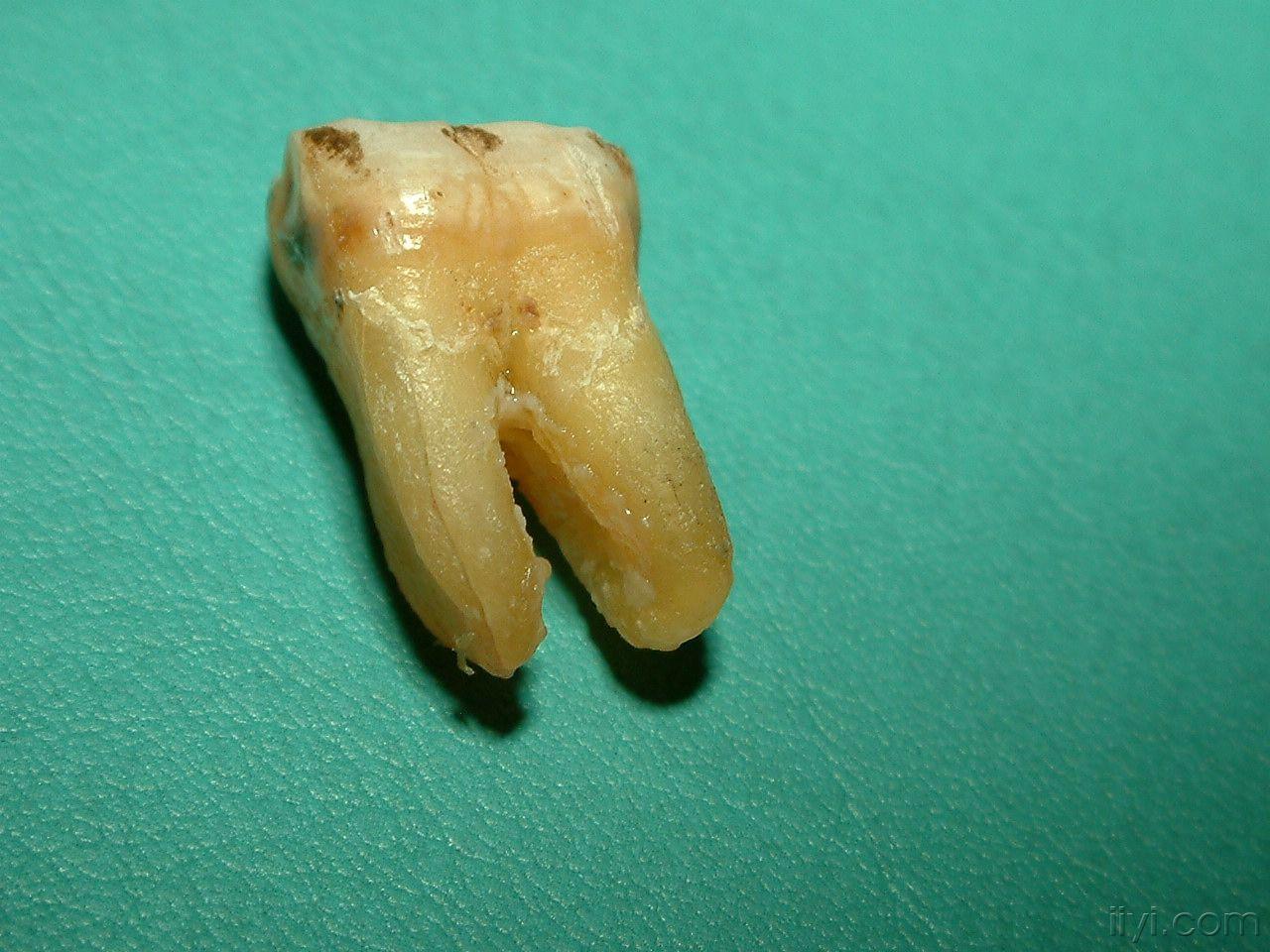 牙根纵裂