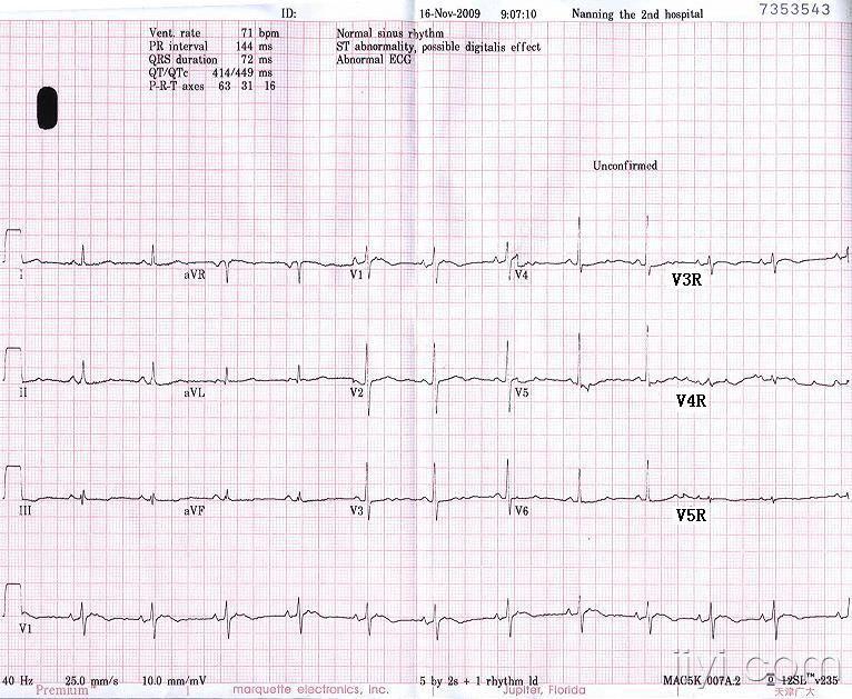 091116----十五导联心电图.jpg